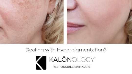 Hyperpigmentation, kalonology, Advanced Vitamin C Serum